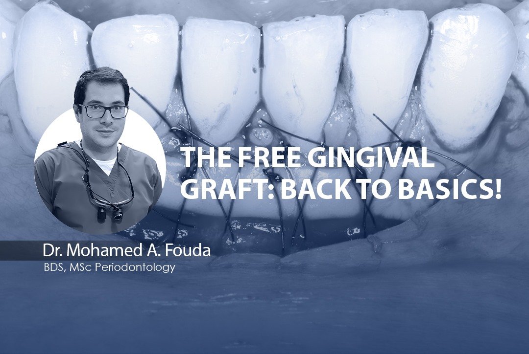 The Free Gingival Graft: Back to Basics